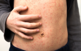 person's torso with measles rash